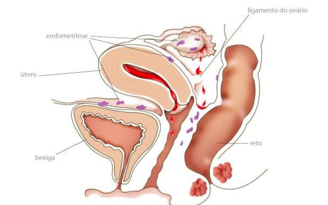 endometriose