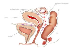 endometriose