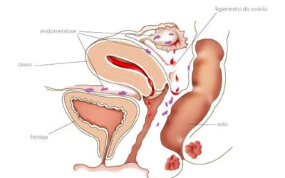 O que é endometriose?