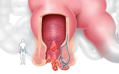 Hemorroidas, todo mundo tem!