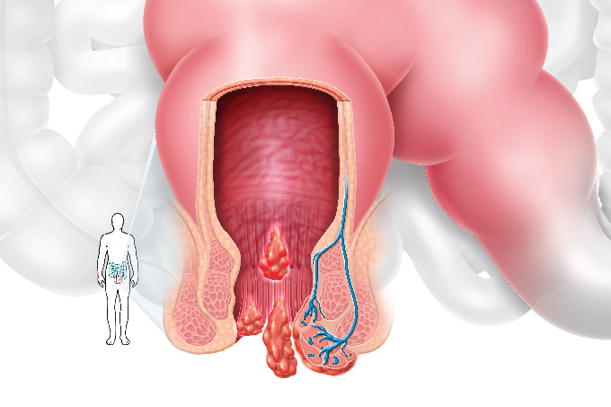 Hemorroidas, todo mundo tem!